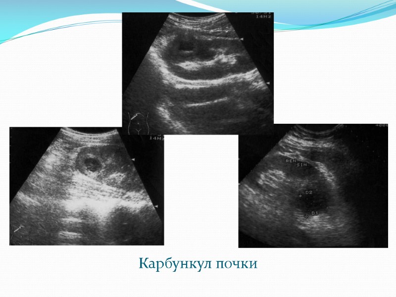 Карбункул почки